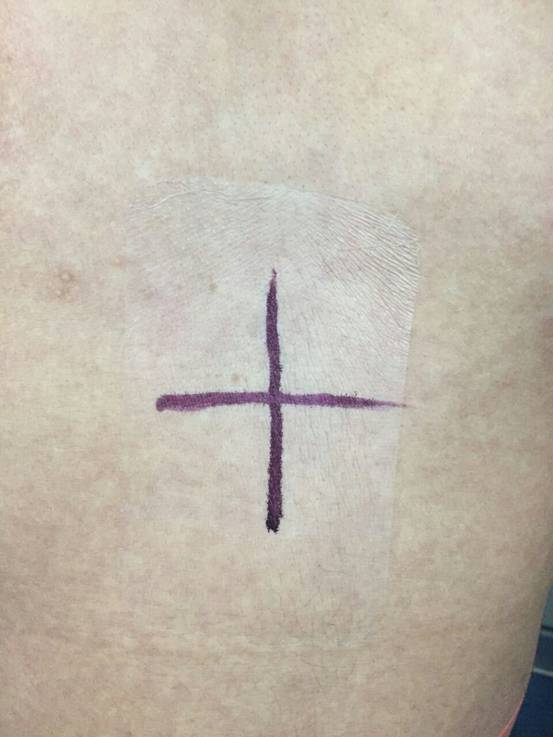 放療標(biāo)記線環(huán)護(hù)膜招商