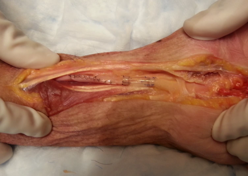 進口外周神經(jīng)導(dǎo)管