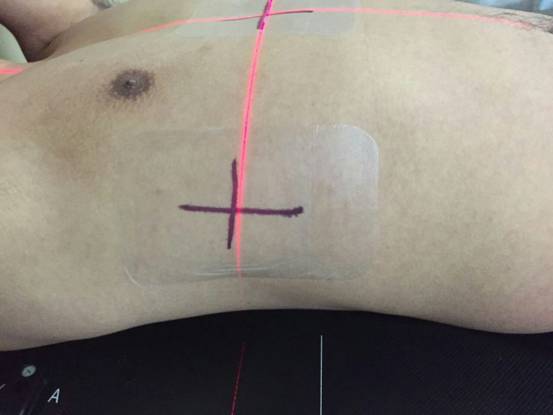 放療用透氣膠貼