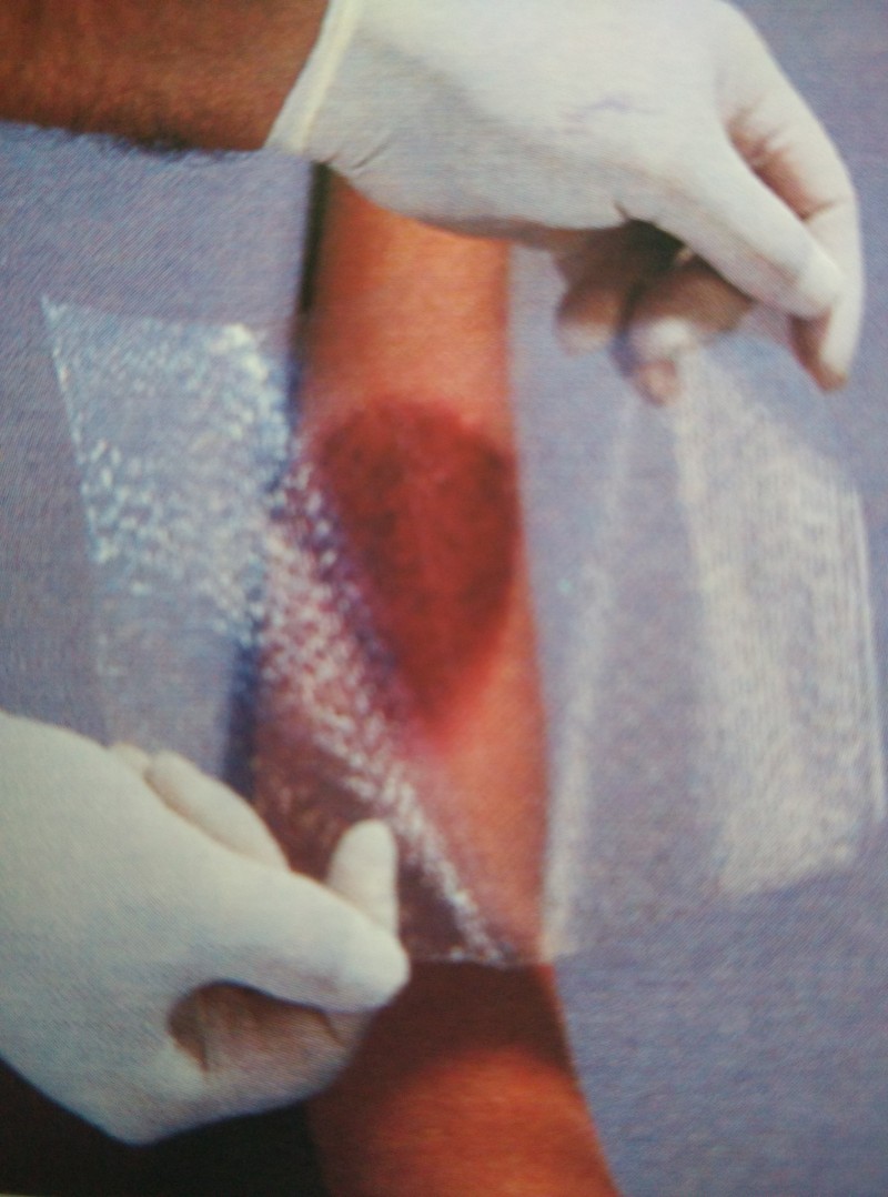 美國進(jìn)口歐密得燒傷科人工皮膜