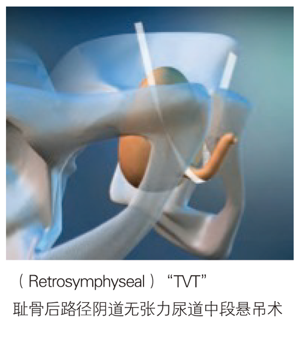 德國PVDF材質(zhì)尿失禁吊帶-SIS/SIS direct