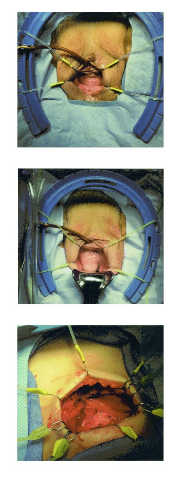 手術擴張器 牽開器 一次性切口固定切開器