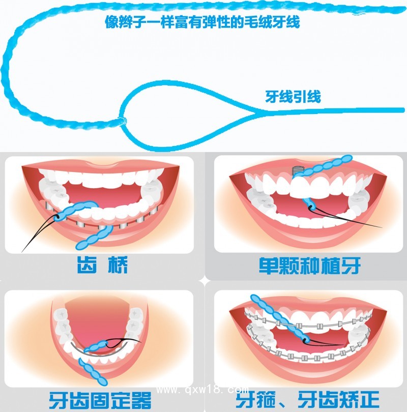 愛(ài)得齒正畸種植專用牙線