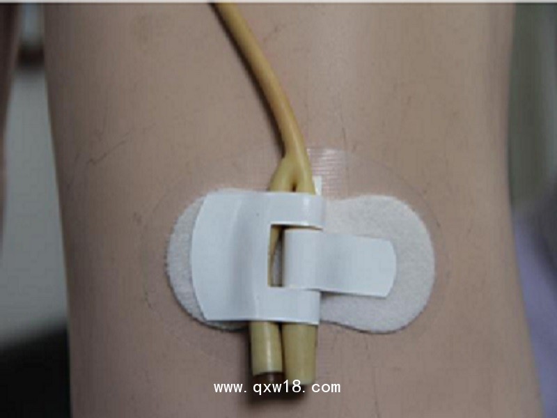 一次性導管固定裝置（導尿管固定裝置）