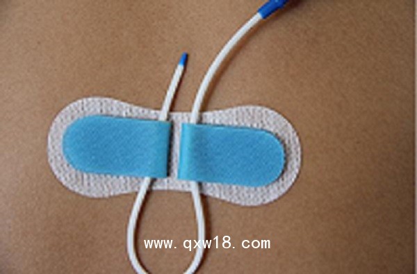 一次性導(dǎo)管固定裝置（留置針延長(zhǎng)管、硬膜外固定裝置）