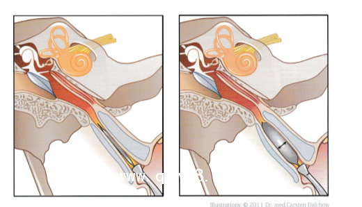 德國球囊擴(kuò)張導(dǎo)管