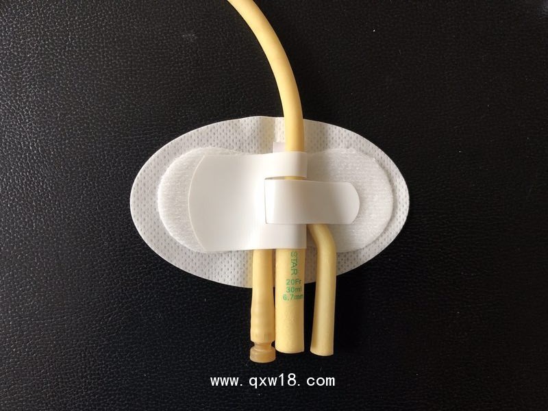 導(dǎo)管固定裝置