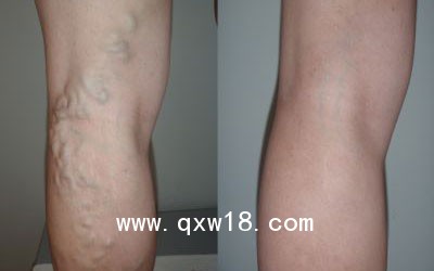 武漢博激VELAS-980nm血管外科大隱靜脈激光治療儀