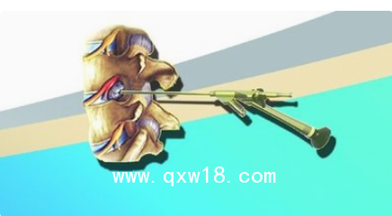 德國(guó)ASAP脊柱內(nèi)窺鏡及手術(shù)器械