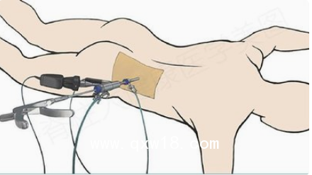 德國(guó)椎間孔鏡手術(shù)系統(tǒng)