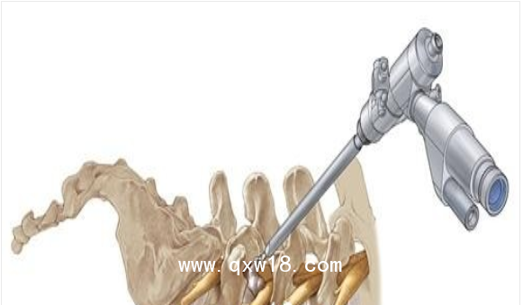 德國(guó)ASAP脊柱內(nèi)窺鏡及手術(shù)器械