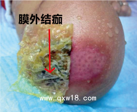 美國進口歐密得Omiderm人工皮膜 傷口敷料