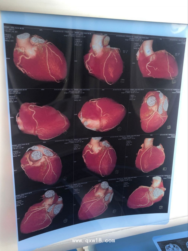 【奧格西】噴墨放射藍(lán)片醫(yī)用膠片