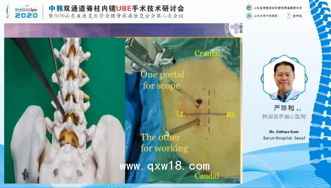 UBE全套脊柱手術器械 BESS/UBE全脊柱內窺鏡手術器械