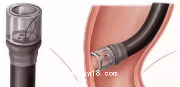 醫(yī)用透明粘膜吸套