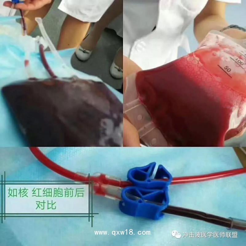 臭氧自體血血袋、三氧自體血血袋、一次性血袋