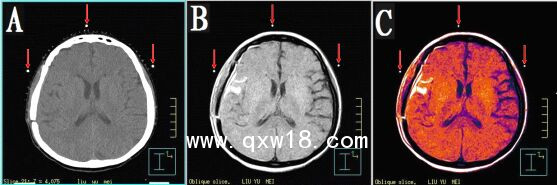 醫(yī)學(xué)圖像體外定位貼（MK⊙CT／MR）