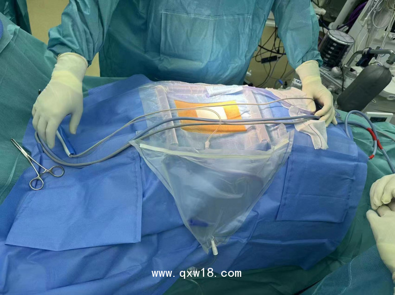 山東奧蘇本骨科脊柱科專用耗材一次性無菌攔水壩手術(shù)貼膜套袋