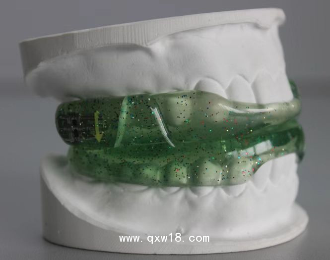 止鼾器（口內(nèi)矯正器）