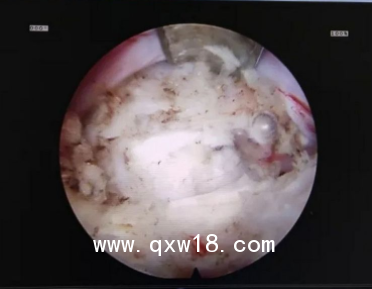 一次性纖維環(huán)縫合器