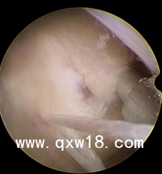 骨科耗材一次性纖維環(huán)縫合手術(shù)