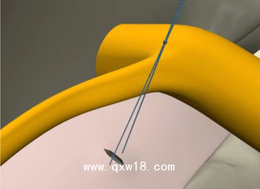 國產(chǎn)骨科非帶量高值耗材一次性纖維環(huán)縫合器