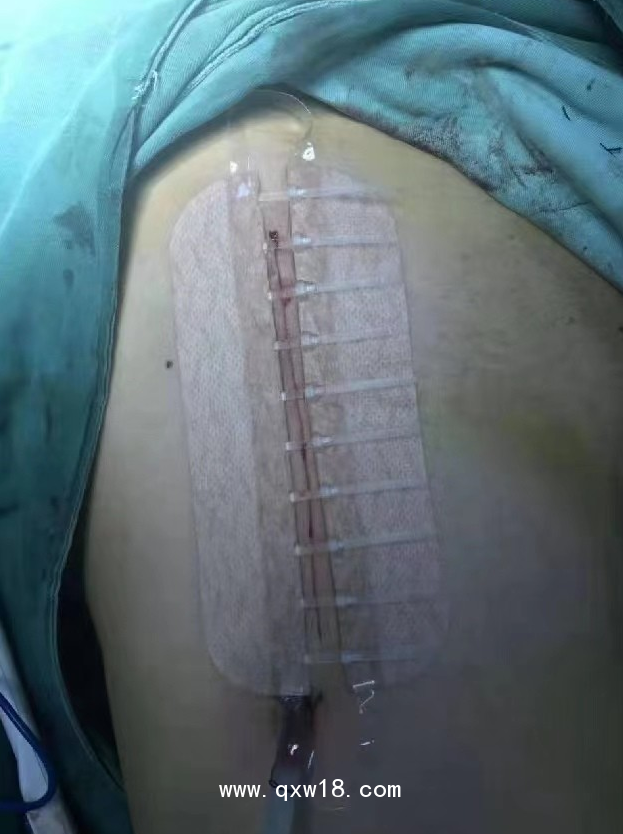 佳痕醫(yī)用免縫拉扣（可調(diào)式無針無創(chuàng)皮膚縫合器）