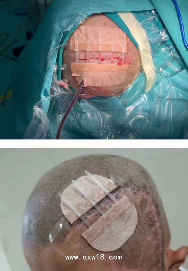 佳痕醫(yī)用免縫拉扣（可調(diào)式無針無創(chuàng)皮膚縫合器）