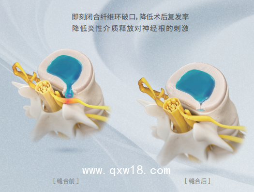 高值耗材一次性纖維環(huán)縫合器