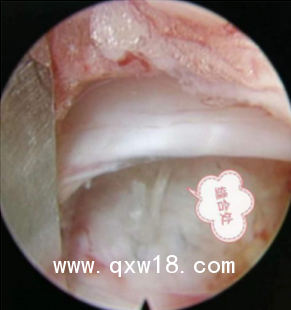 一次性使用纖維環(huán)縫合器縫合技術(shù)