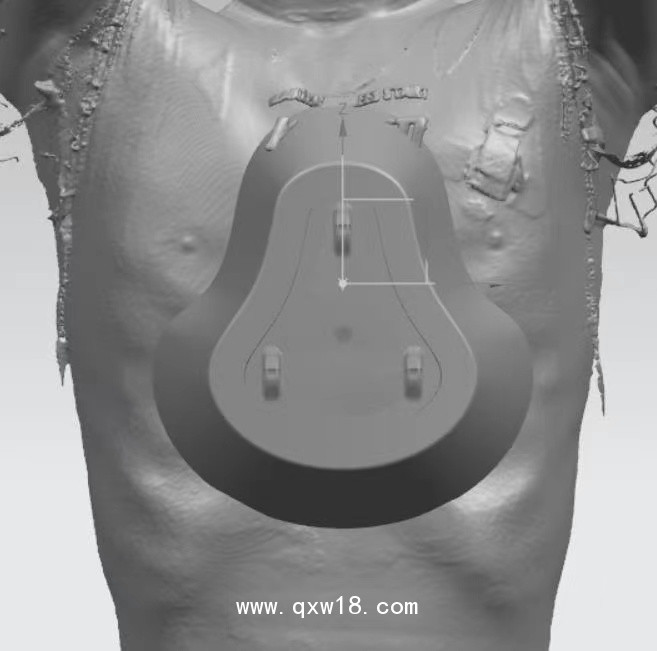 漏斗胸矯正器，負(fù)壓吸盤(pán)