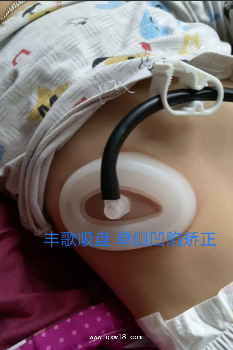 漏斗胸矯正器，負(fù)壓吸盤(pán)