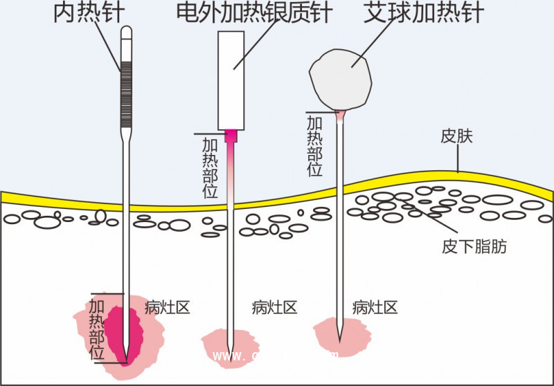 內(nèi)熱針治療儀40路 50路全國招商