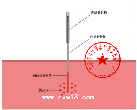 百士康0.7MM*120mm 內熱針 內熱式針灸治療儀 熱量直達病灶