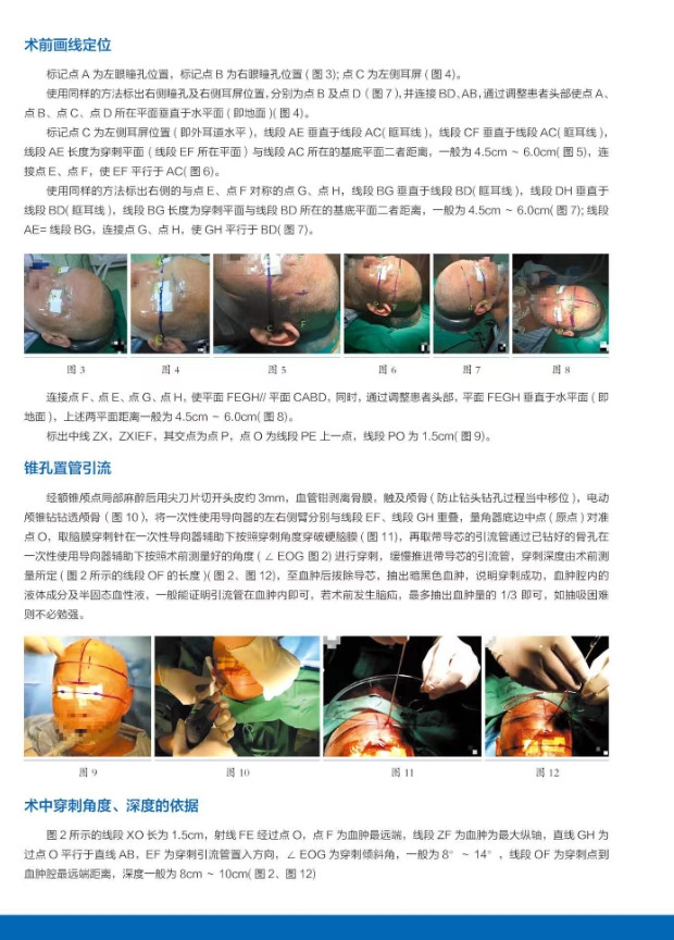 一次性使用導(dǎo)向器（腦血管穿刺定位）