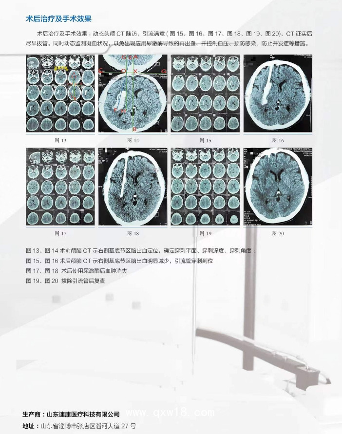 一次性使用導(dǎo)向器（腦血管穿刺定位）