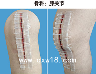 一次性皮膚縫合器/醫(yī)用無針縫合器/醫(yī)用免縫拉鏈/一次性皮膚吻合器/一次性皮膚減張器