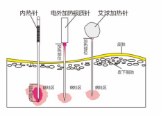 內(nèi)熱針針具、銀質(zhì)針設(shè)備 內(nèi)熱針治療儀