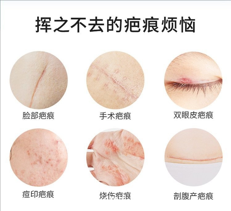 疤痕貼 疤痕凝膠生產(chǎn)廠家—全國(guó)招商承接代加工—可來(lái)樣加工按需定制