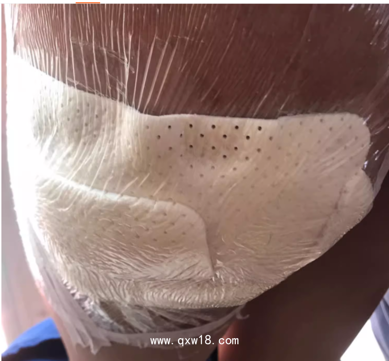 醫(yī)用透明敷貼20x30cm封閉負壓引流VSD 護創(chuàng)無菌敷貼膜vsd