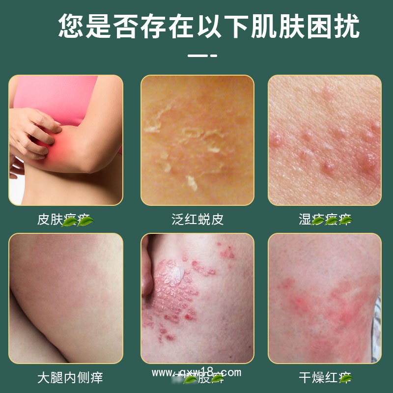 濕疹膏加工廠家 成人兒童皮膚護理舒緩抑菌濕疹膏oem貼牌代加工