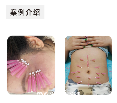中醫(yī)埋線(xiàn) 聚對(duì)二氧環(huán)己酮面部埋植線(xiàn)  針線(xiàn)一體 （PPDO）