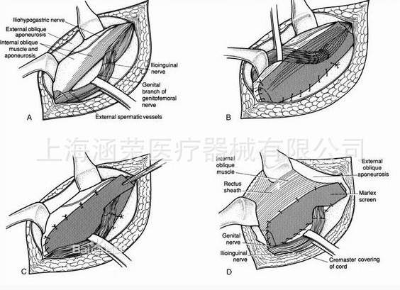 疝修補手術(shù)示意圖