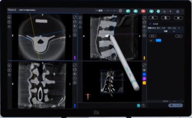 骨科手術(shù)機(jī)器人數(shù)據(jù)分析 骨科手術(shù)機(jī)器人數(shù)據(jù)分析