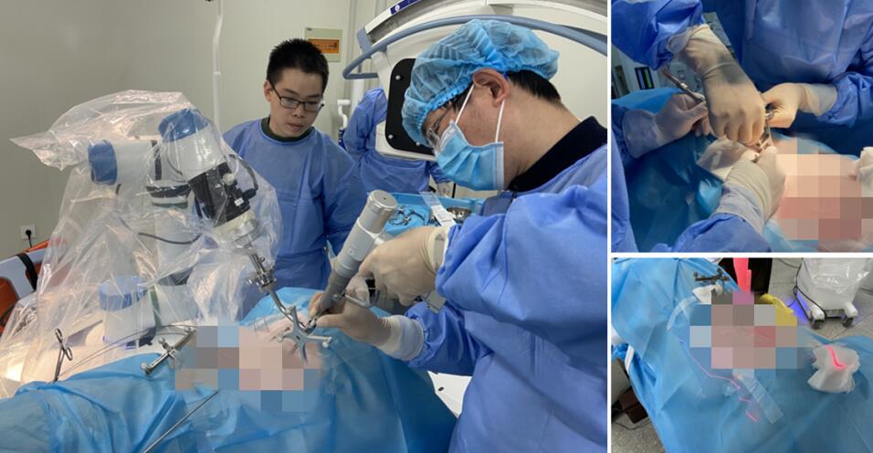 骨科手術(shù)機(jī)器人手術(shù)創(chuàng)面小 骨科手術(shù)機(jī)器人手術(shù)創(chuàng)面小