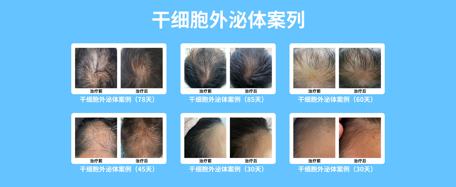 干細(xì)胞生發(fā)