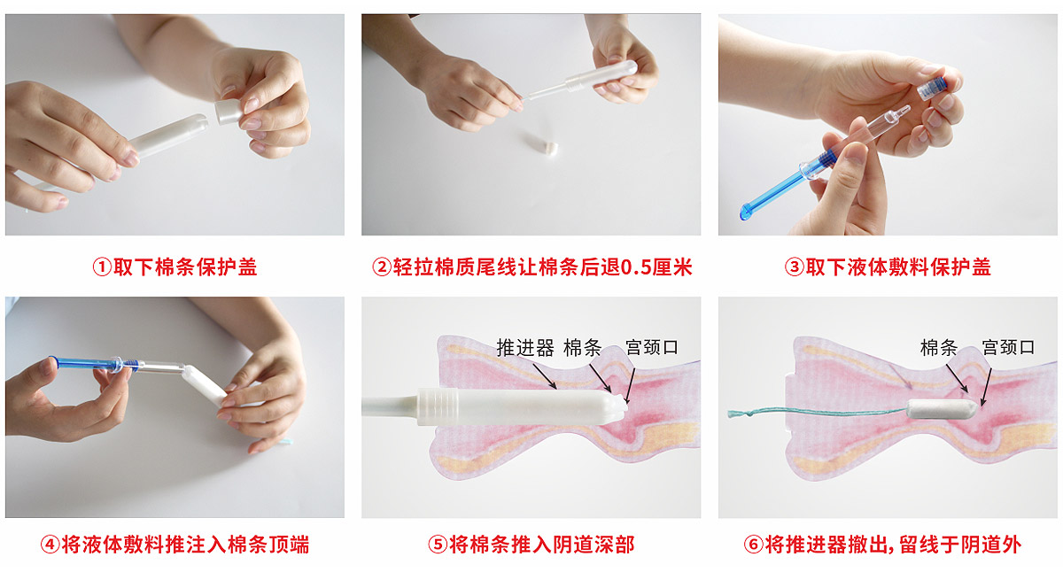 宮腔填塞吸附栓、陰道填塞吸附栓、陰道填塞止血吸附栓